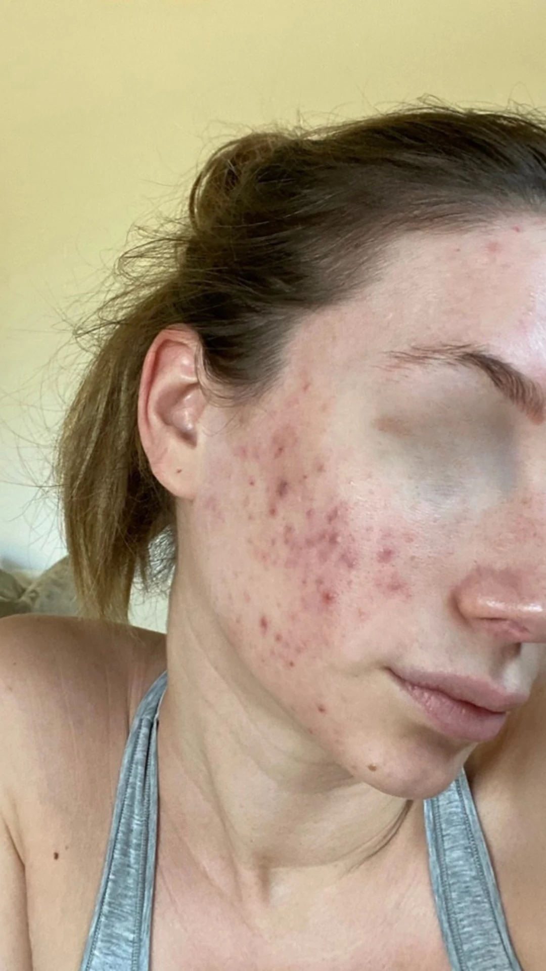 Client before photo — Hormonal Acne & Hyperpigmentation