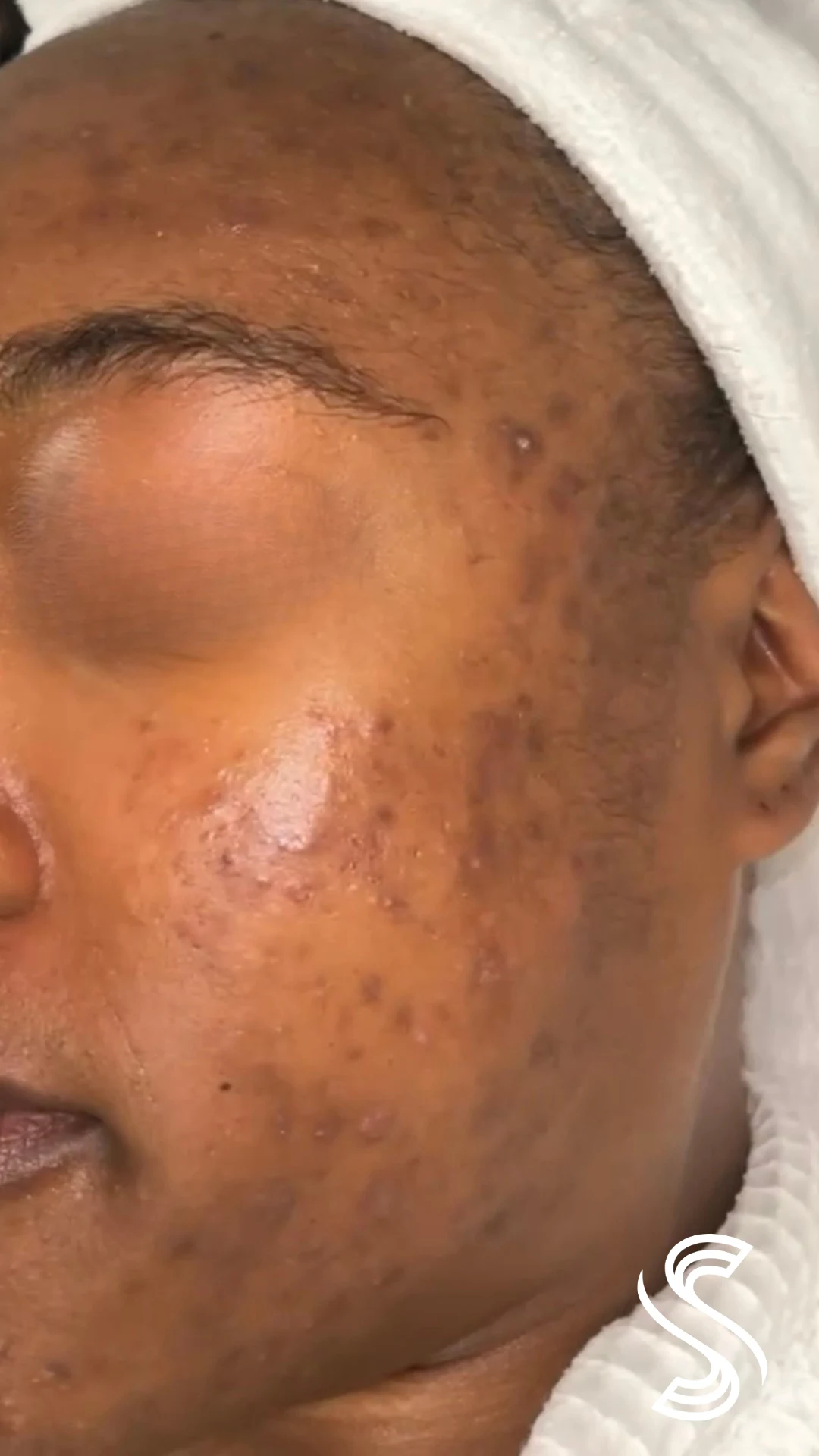 Client before photo — Hormonal Acne & Hyperpigmentation